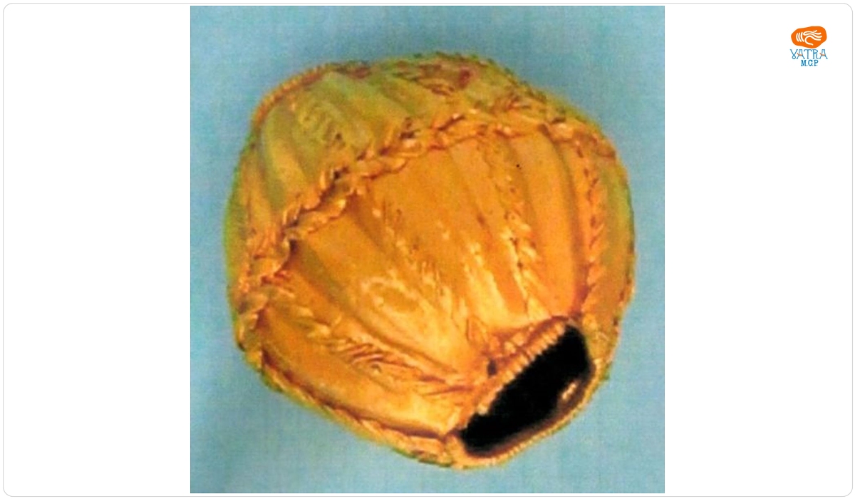 Mărgea globulară